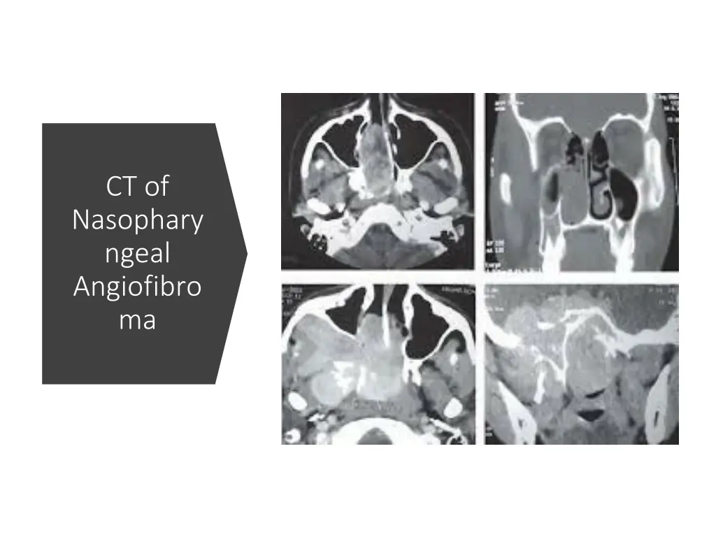 ct of nasophary ngeal angiofibro ma