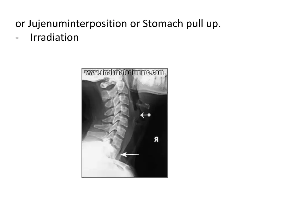 or jujenuminterposition or stomach pull
