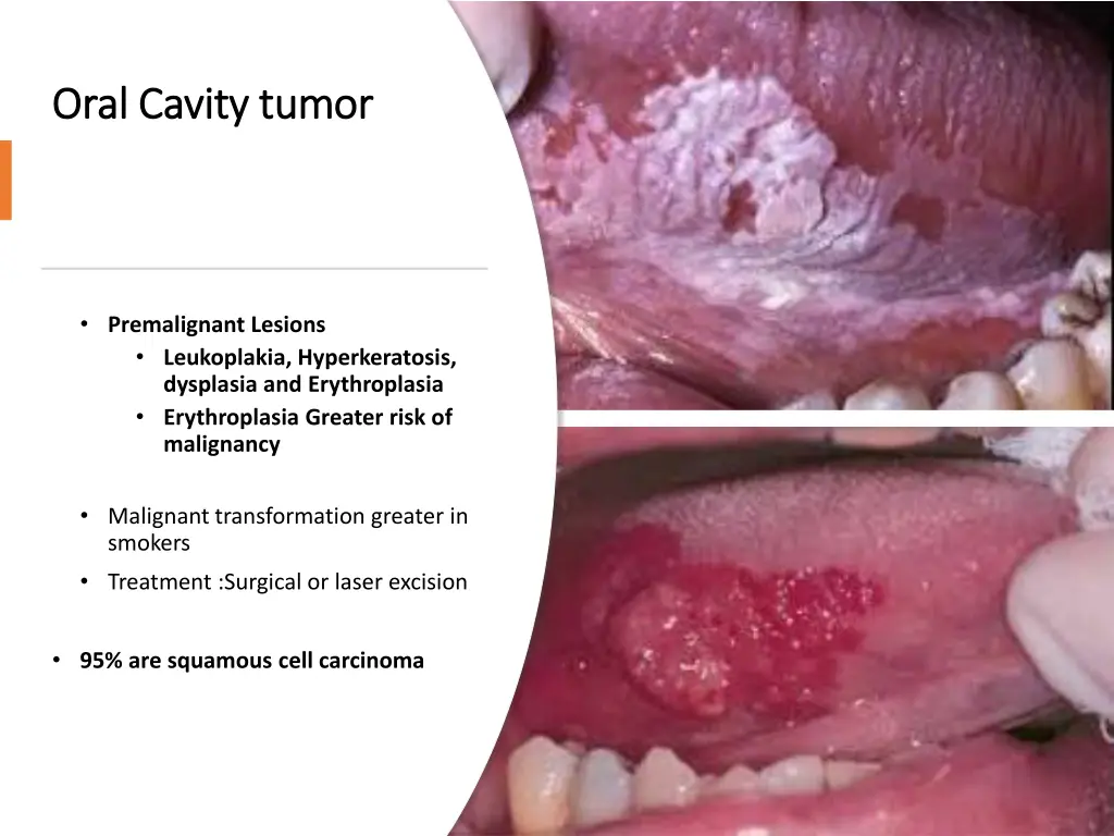 oral cavity tumor oral cavity tumor 1