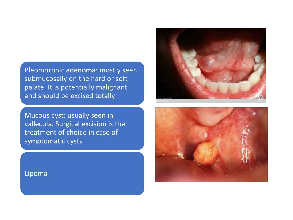 pleomorphic adenoma mostly seen submucosally