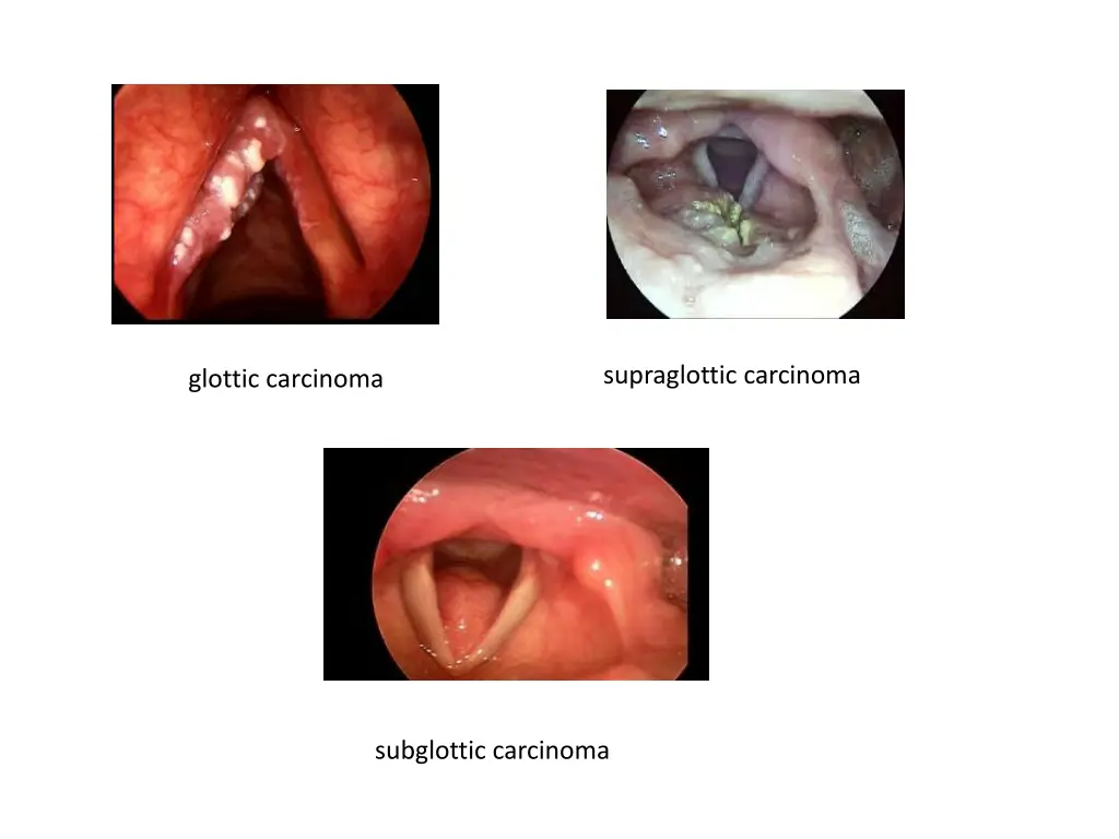 supraglottic carcinoma