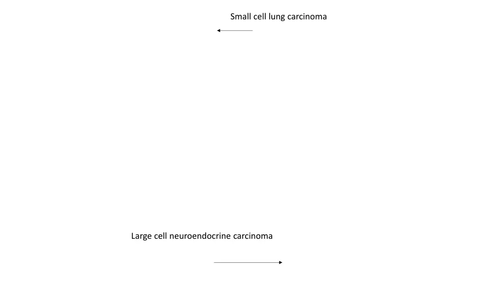 small cell lung carcinoma 1