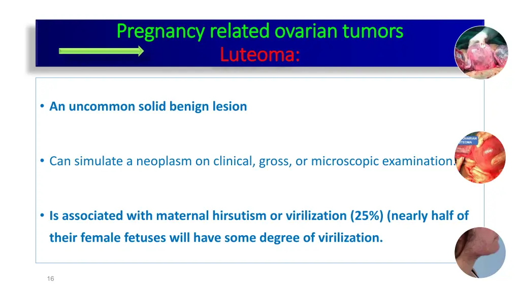 pregnancy related ovarian tumors pregnancy