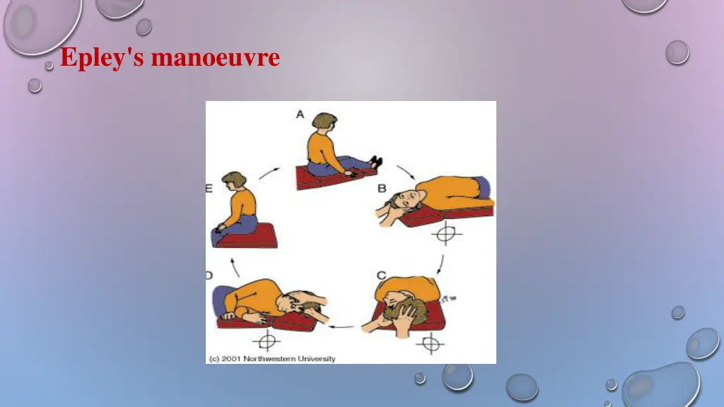 epley s manoeuvre 1