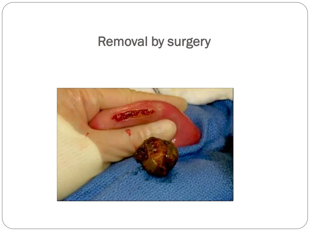 removal by surgery removal by surgery