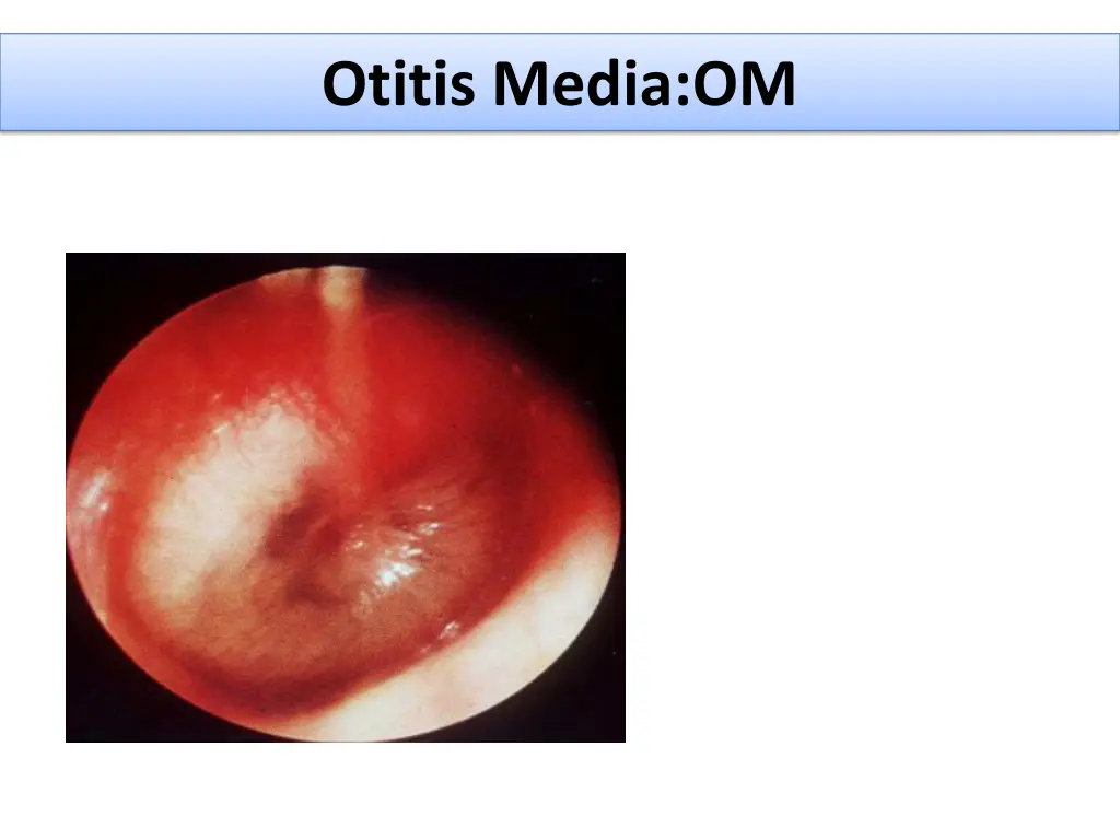 otitis media om 1