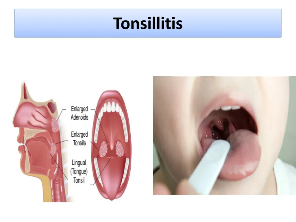 tonsillitis 1