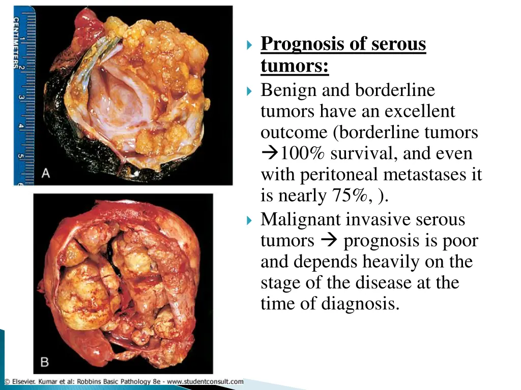prognosis of serous tumors benign and borderline