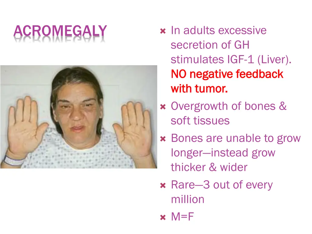acromegaly