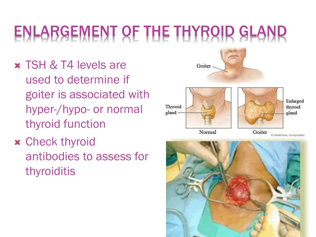 enlargement of the thyroid gland