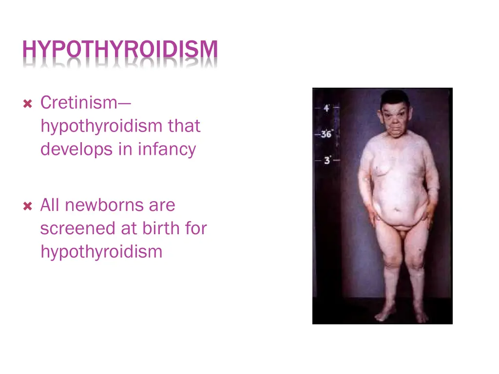 hypothyroidism 1