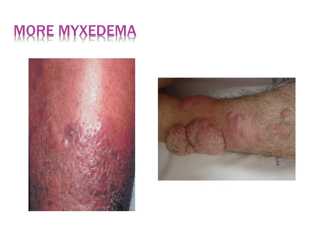 more myxedema