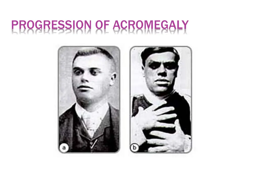 progression of acromegaly