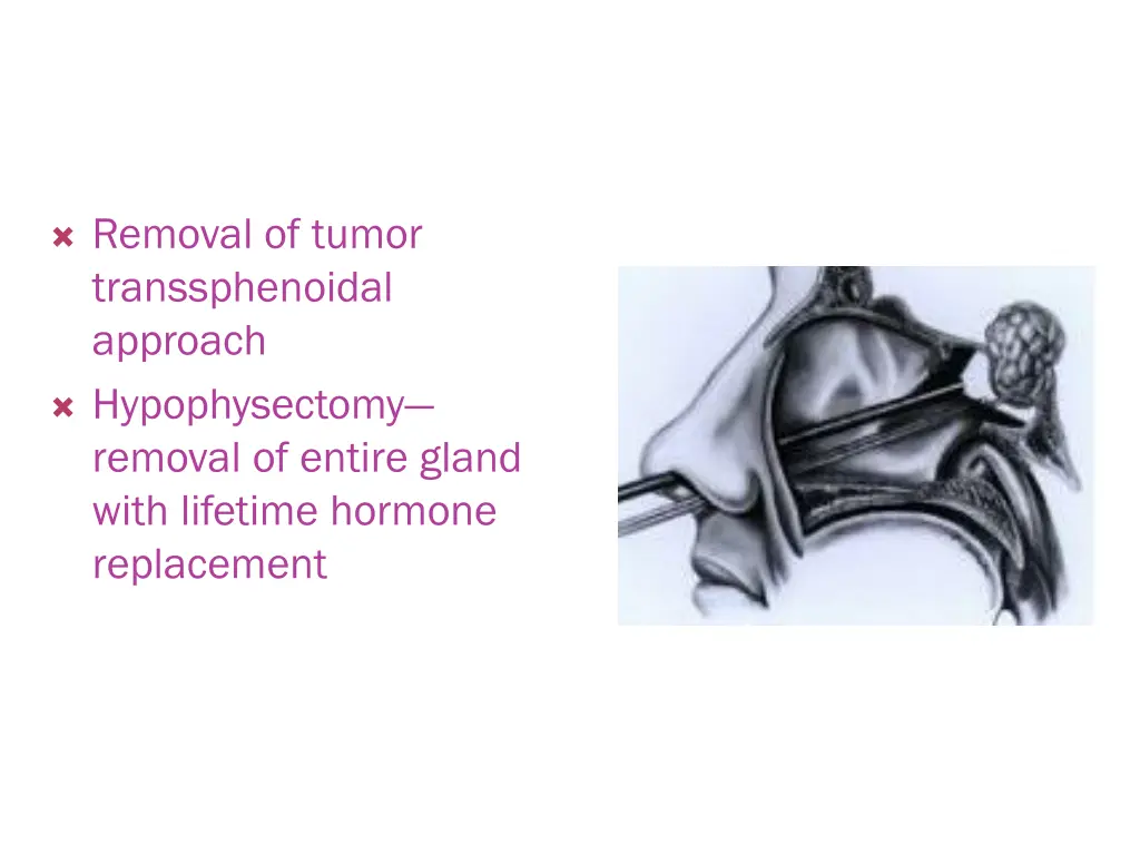 removal of tumor transsphenoidal approach