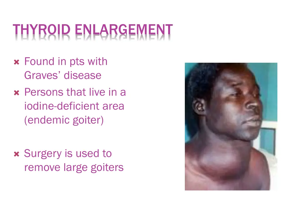 thyroid enlargement 1