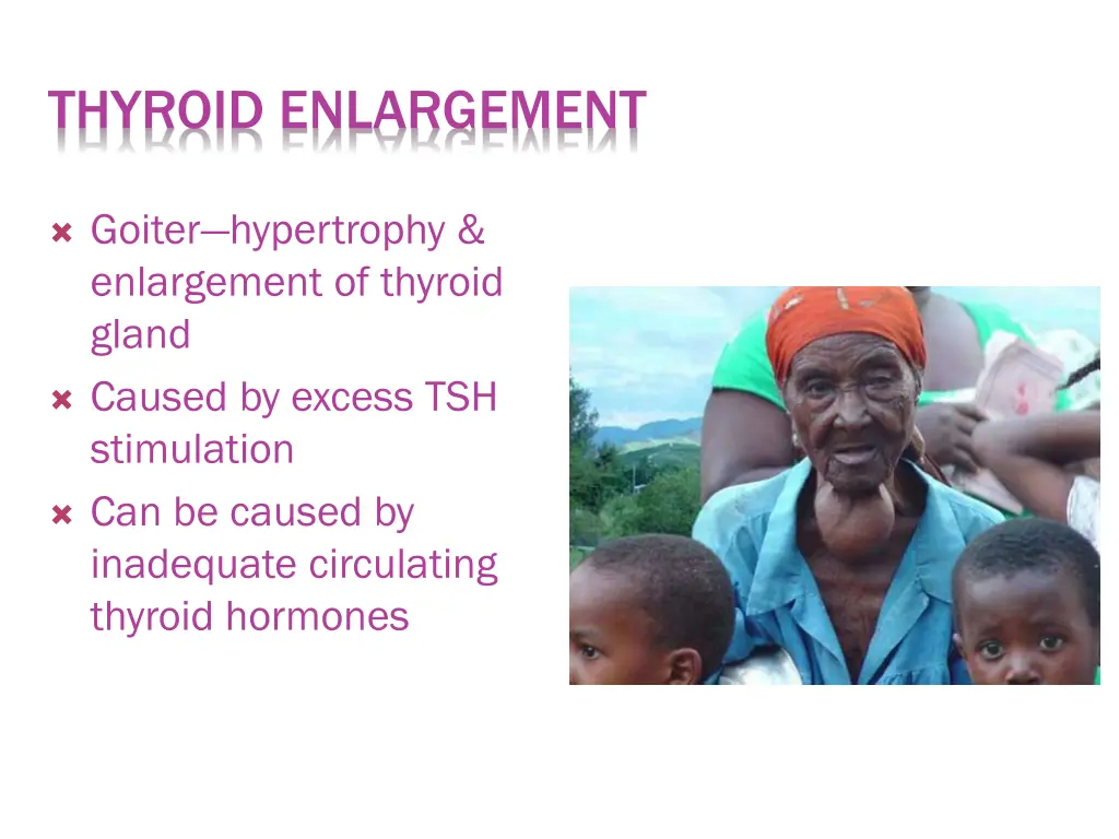 thyroid enlargement