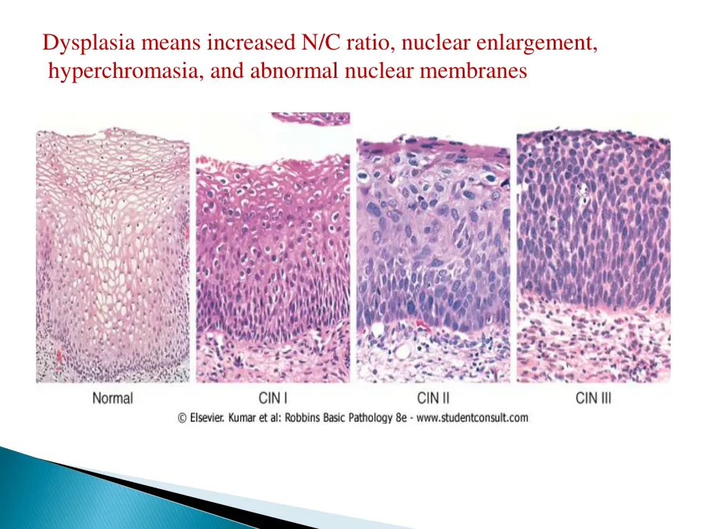 dysplasia means increased n c ratio nuclear