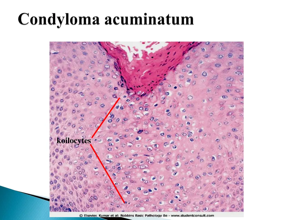 koilocytes