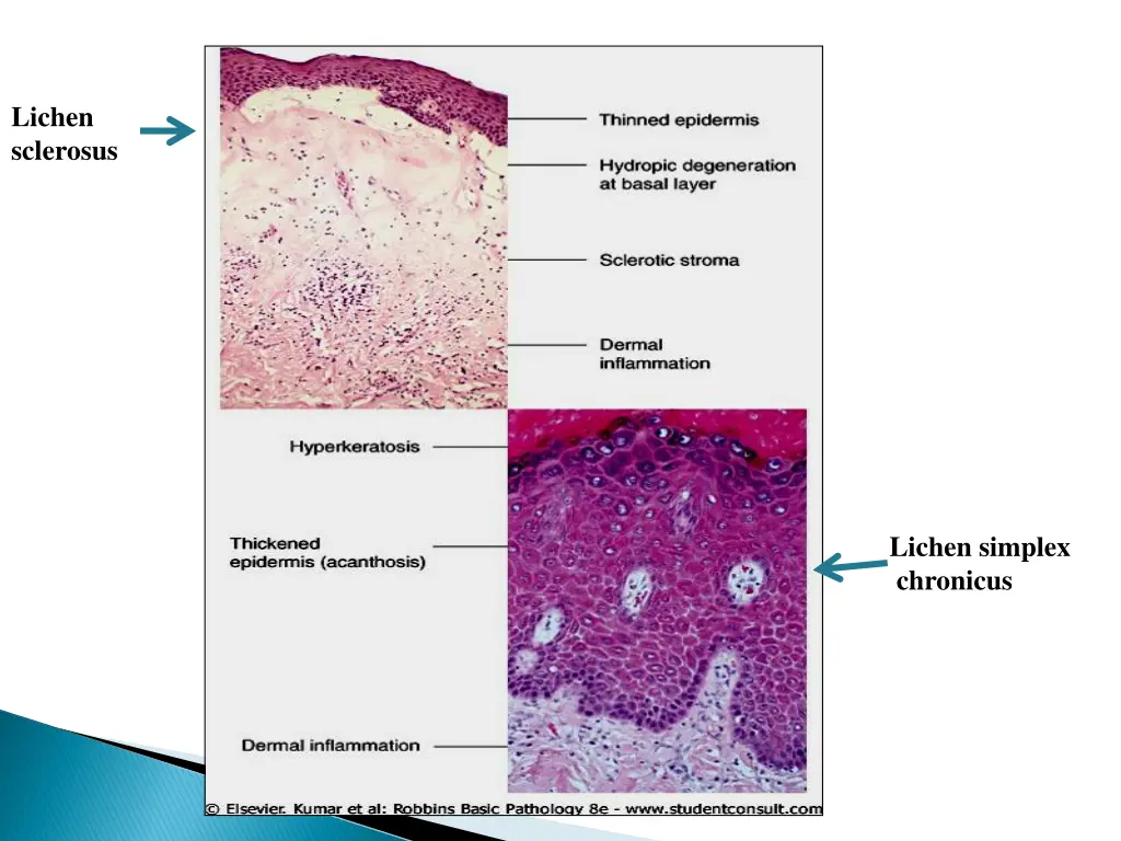 lichen sclerosus