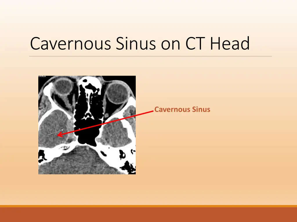 cavernous sinus on ct head