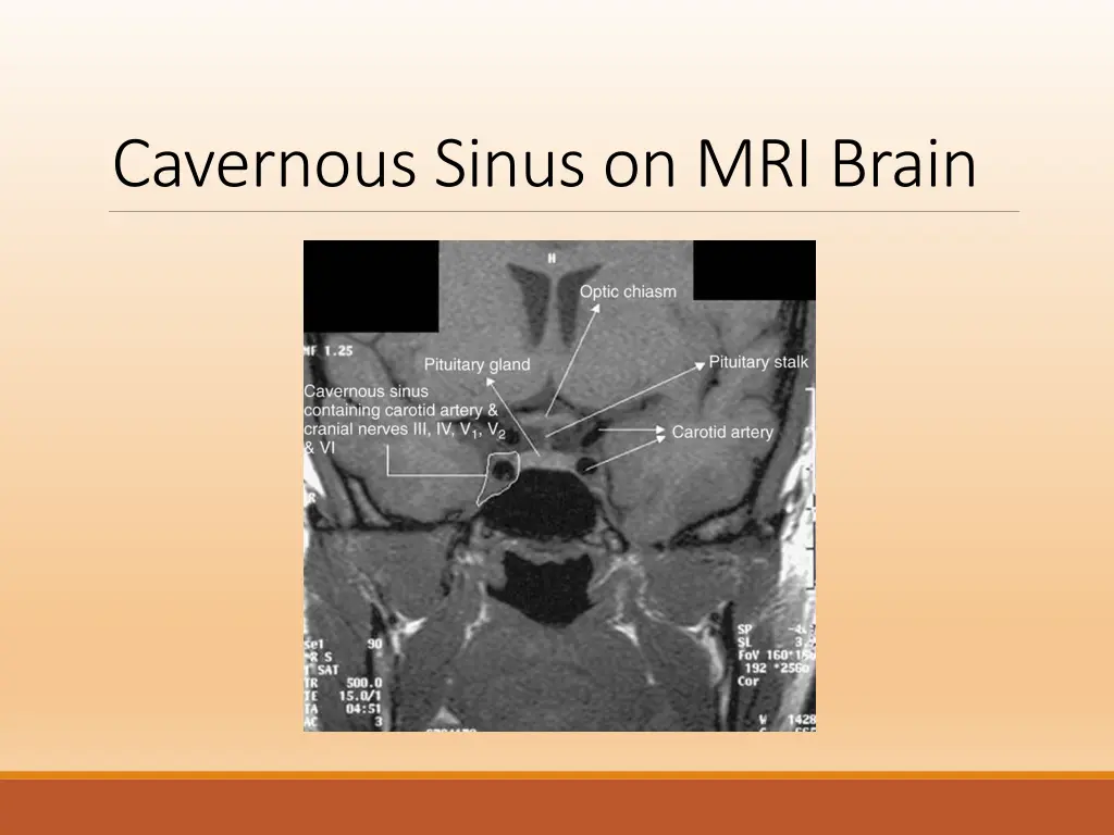 cavernous sinus on mri brain 1