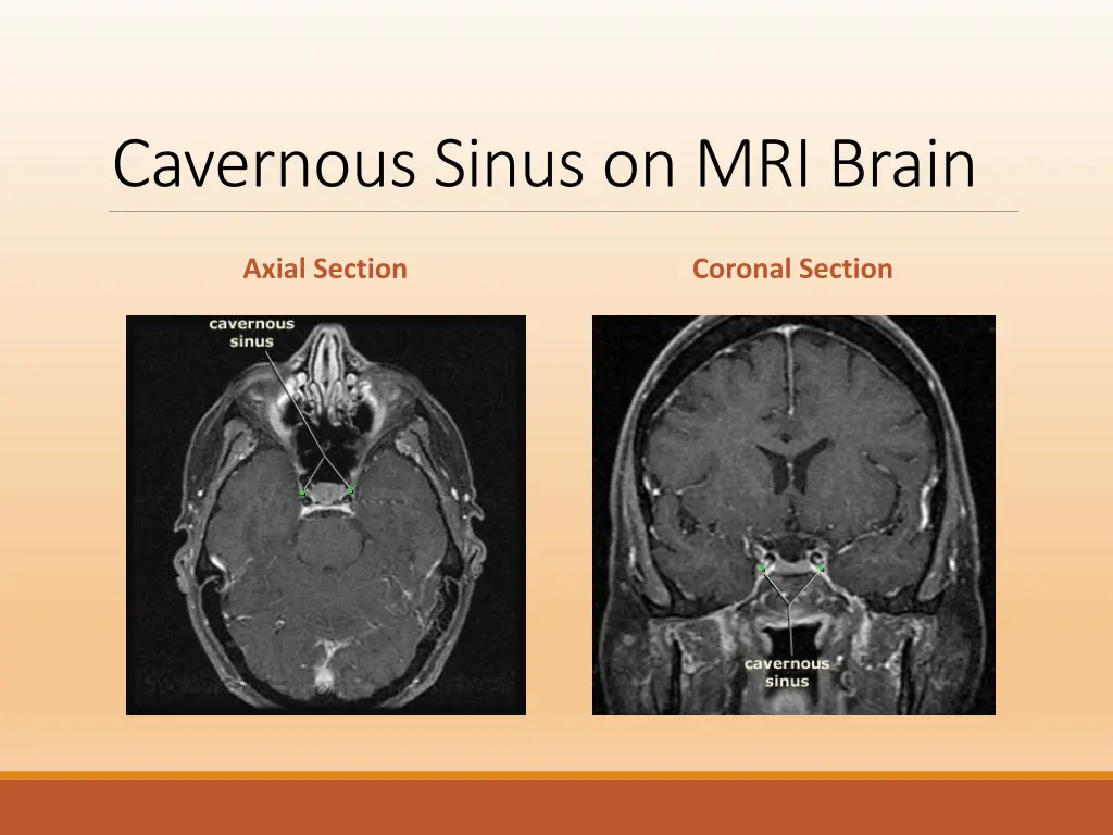 cavernous sinus on mri brain