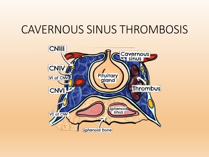 cavernous sinus thrombosis
