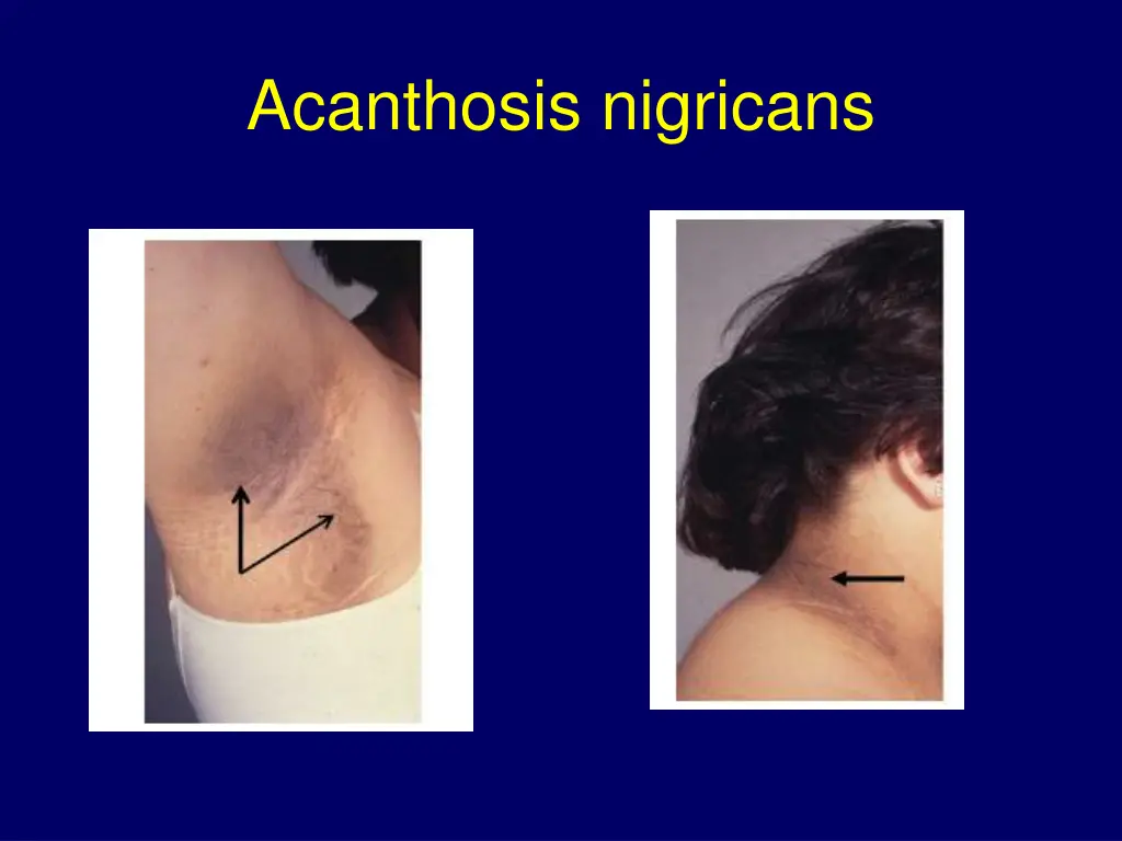 acanthosis nigricans
