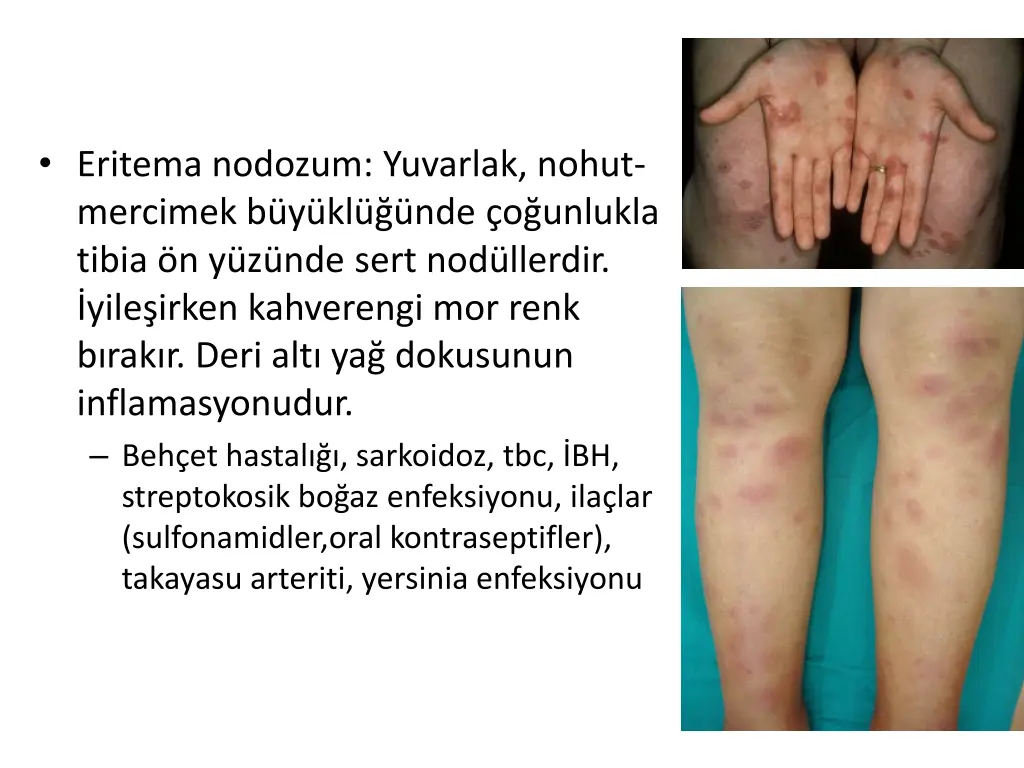 eritema nodozum yuvarlak nohut mercimek