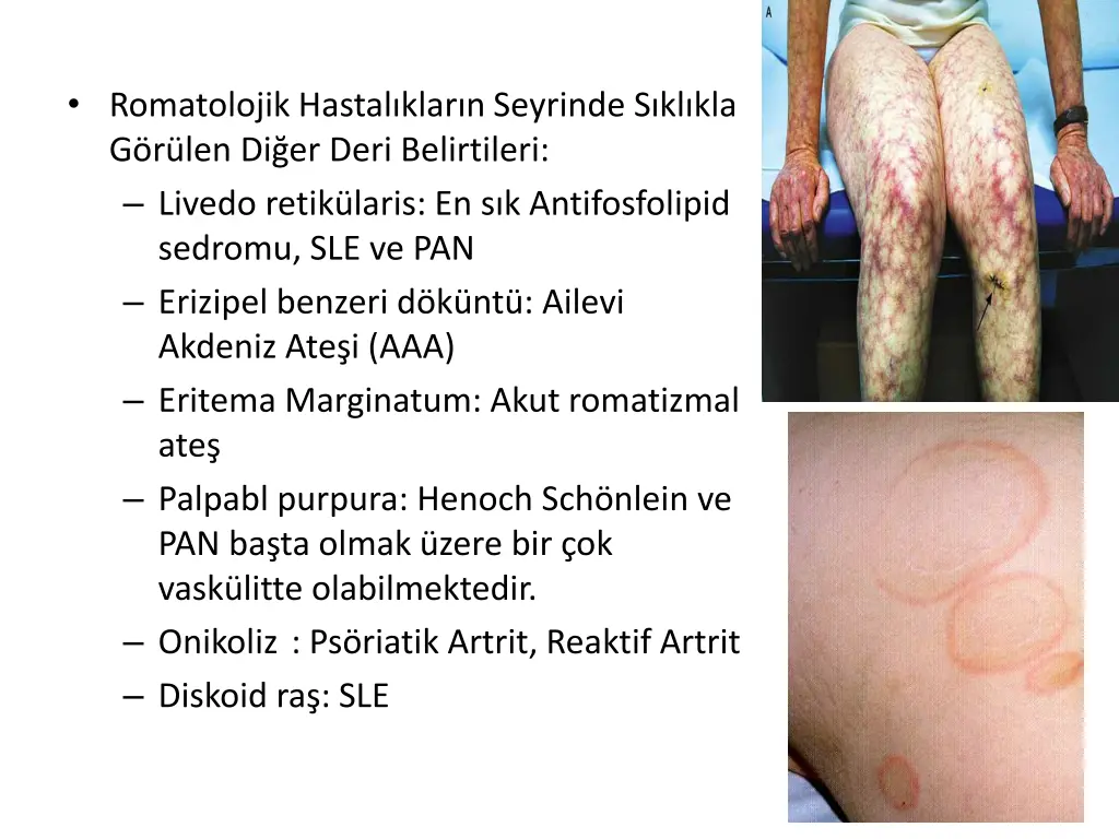 romatolojik hastal klar n seyrinde