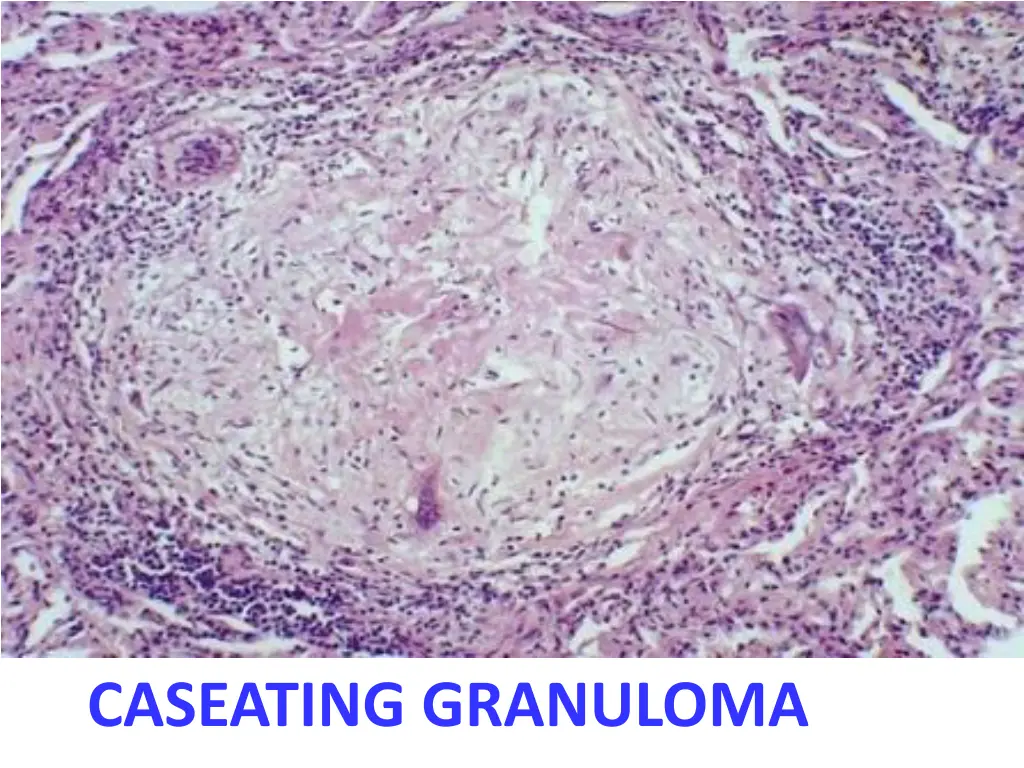 caseating granuloma