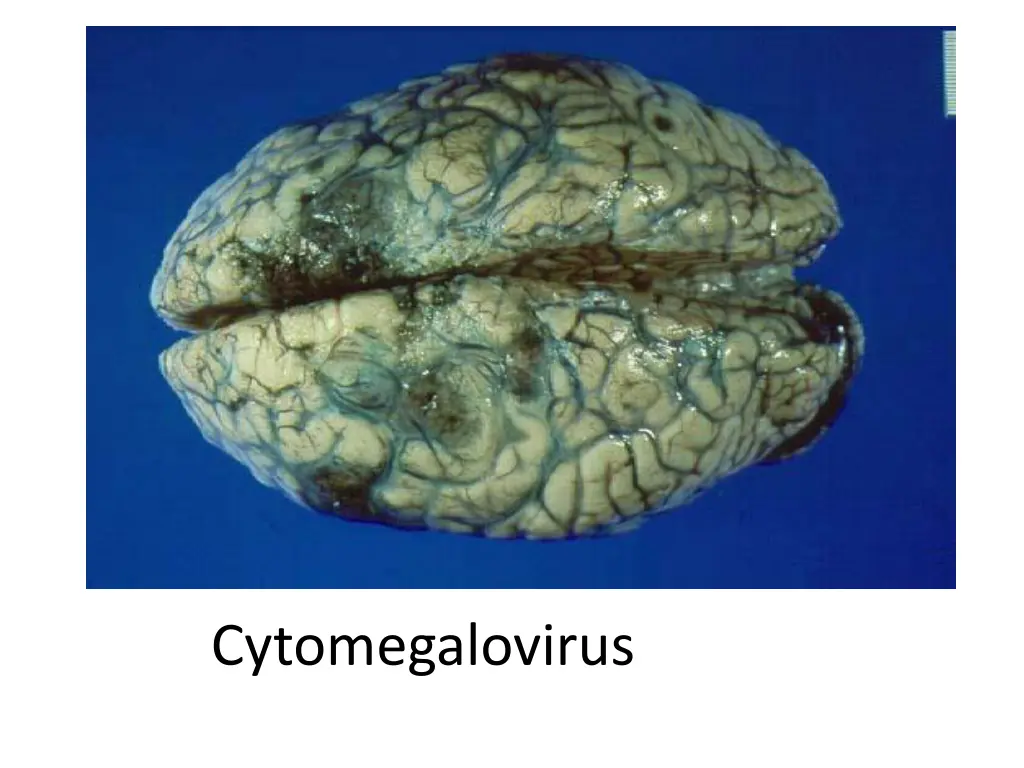 cytomegalovirus