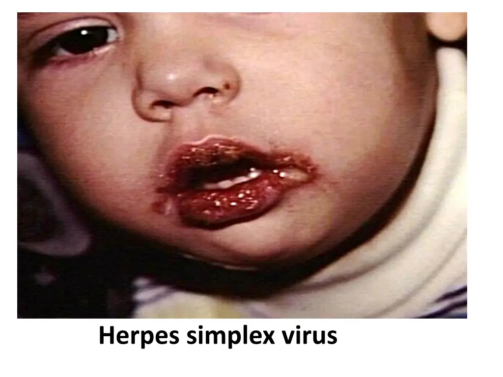 herpes simplex virus