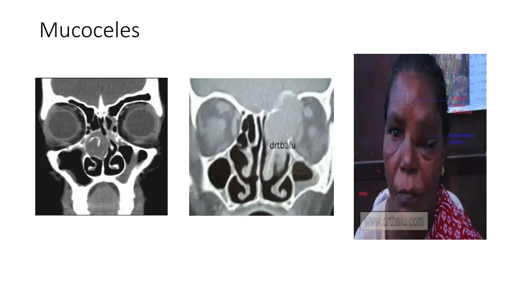 mucoceles