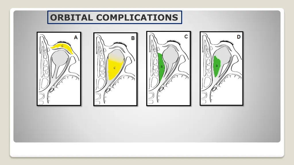 orbital complications 1