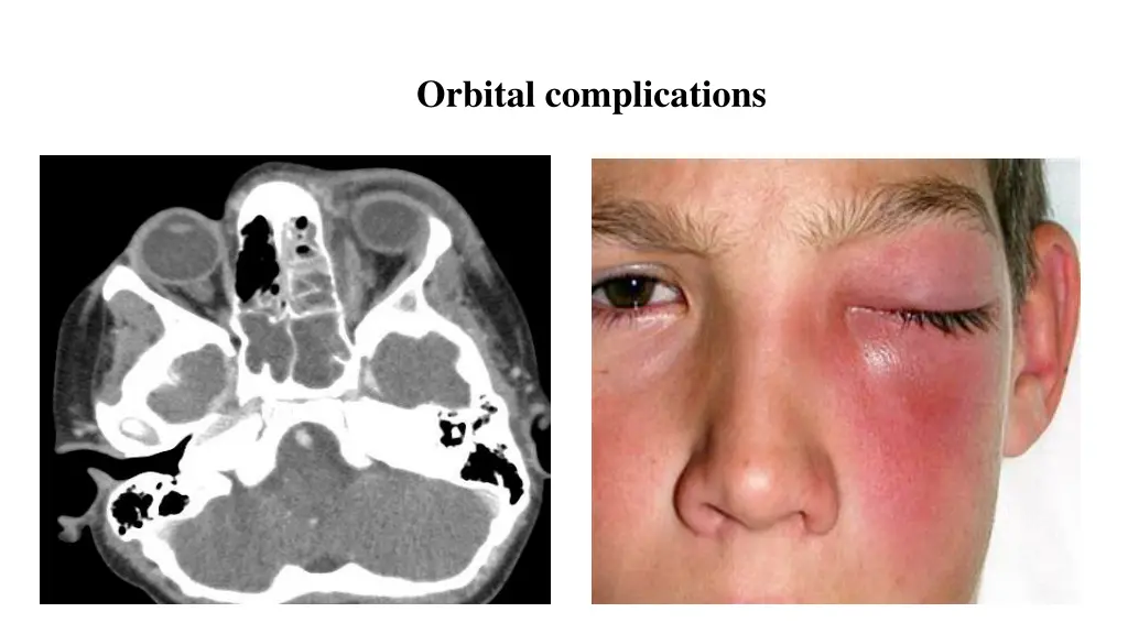 orbital complications
