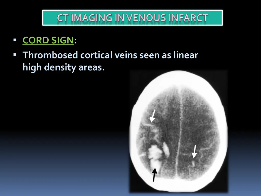 cord sign thrombosed cortical veins seen