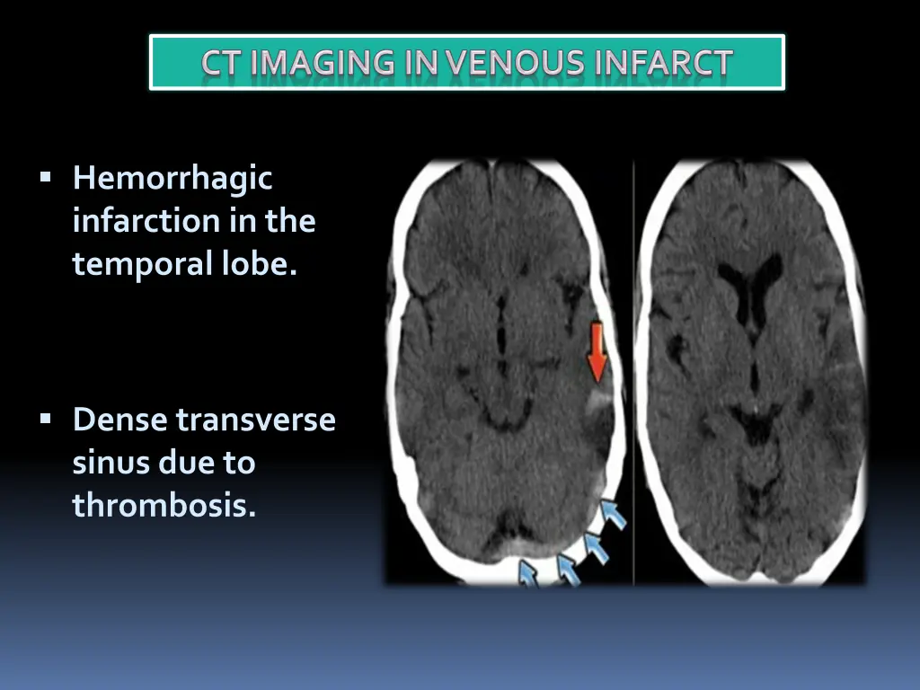 hemorrhagic infarction in the temporal lobe