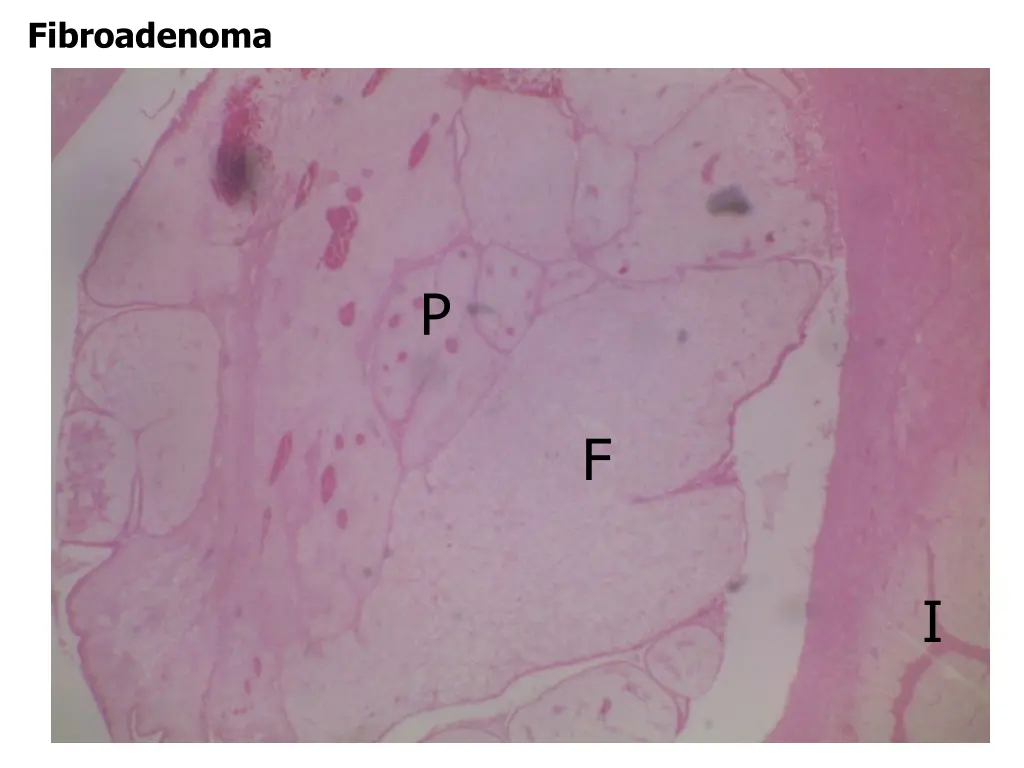 fibroadenoma 1