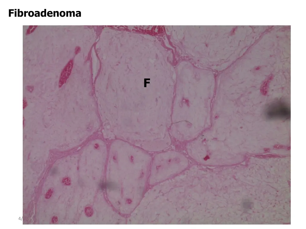 fibroadenoma