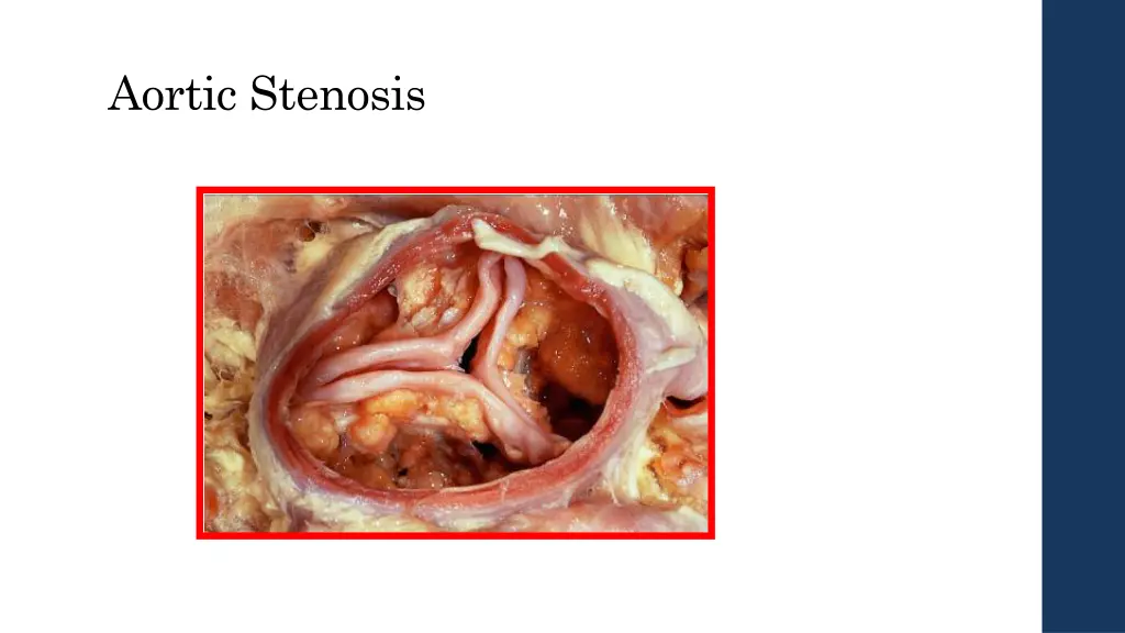 aortic stenosis