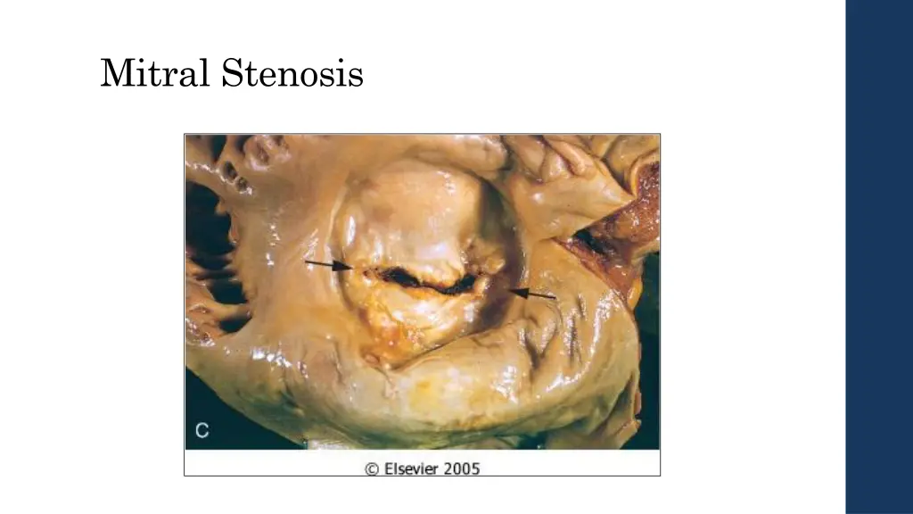 mitral stenosis 1