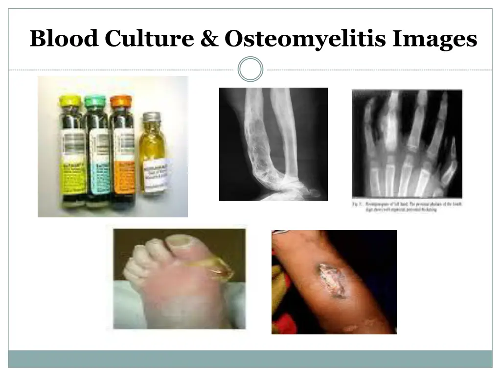 blood culture osteomyelitis images