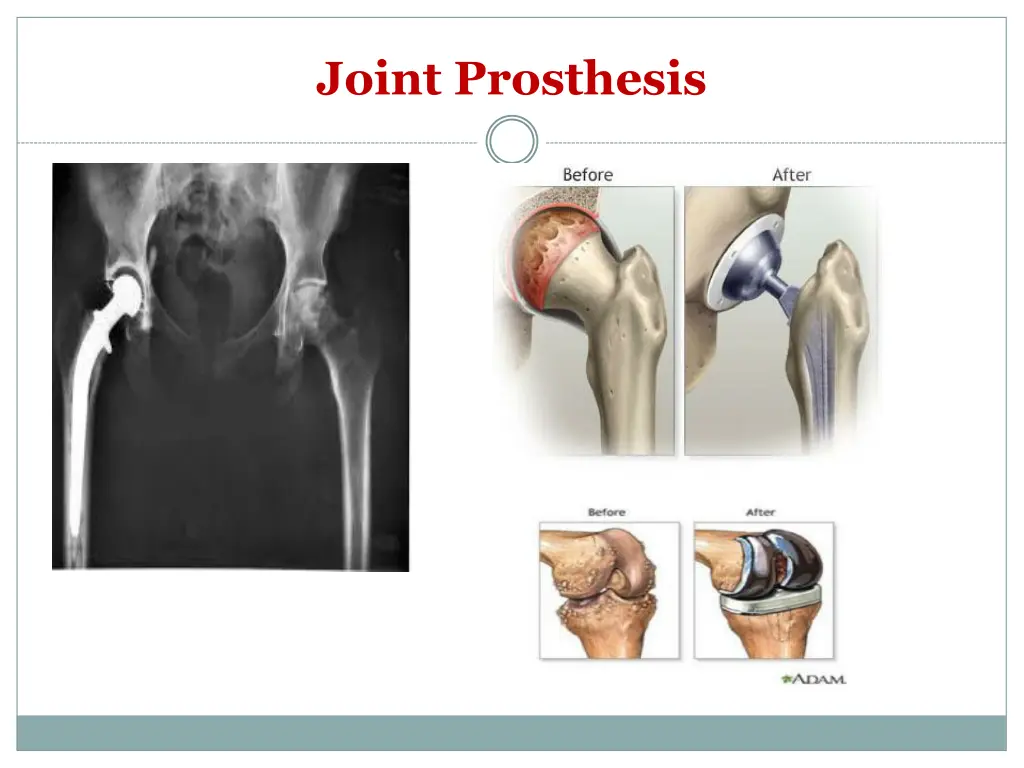 joint prosthesis