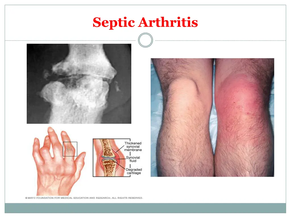 septic arthritis
