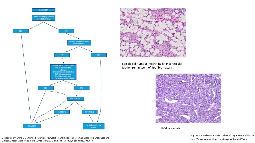 spindle cell tumour infiltrating