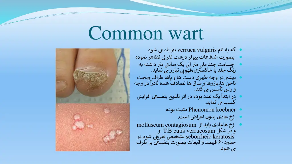 common wart