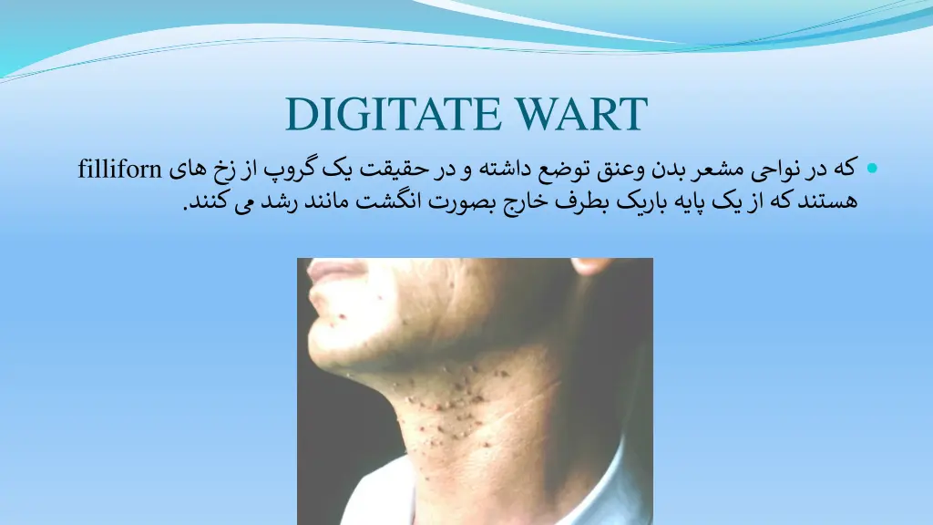 digitate wart