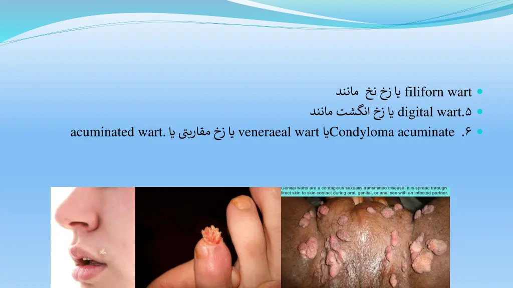filiforn wart digital wart