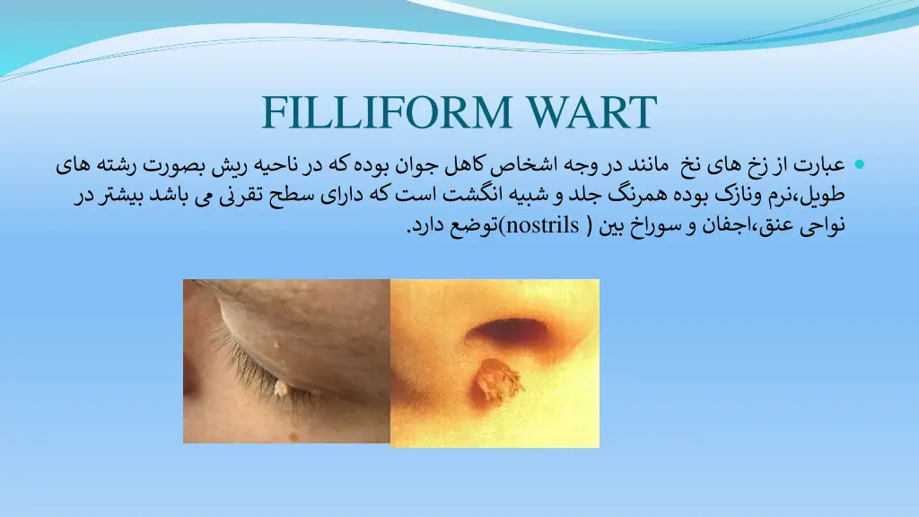 filliform wart